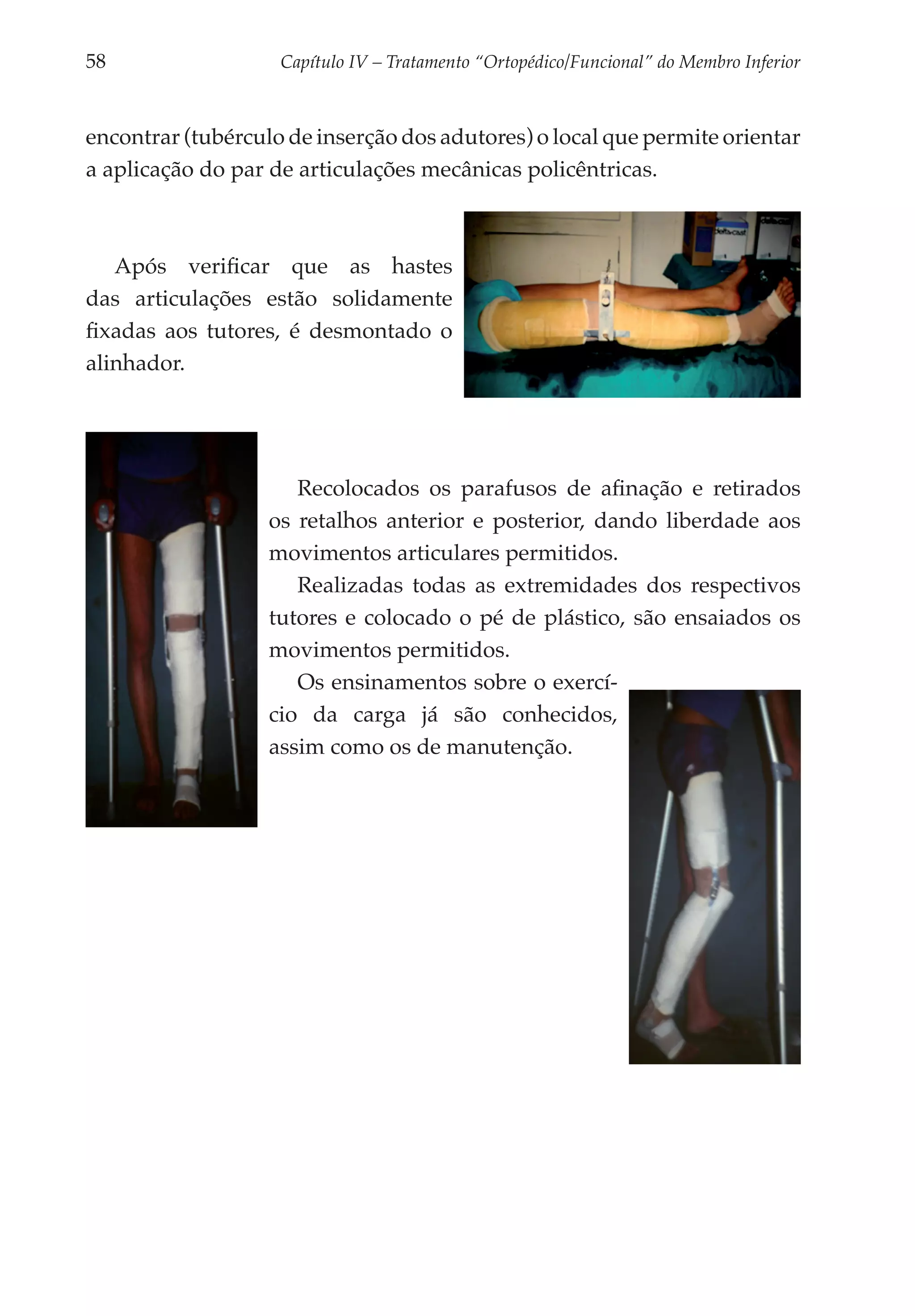 58	                 Capítulo IV – Tratamento “Ortopédico/Funcional” do Membro Inferior



encontrar (tubérculo de inserção dos adutores) o local que permite orientar
a aplicação do par de articulações mecânicas policêntricas.



   Após verificar que as hastes
das articulações estão solidamente
fixadas aos tutores, é desmontado o
alinhador.




                      Recolocados os parafusos de afinação e reti­ ados
                                                                   r
                   os retalhos anterior e posterior, dando liberdade aos
                   movimentos articulares permi­ idos.
                                                 t
                      Realizadas todas as extremidades dos respectivos
                   tutores e colocado o pé de plástico, são ensaiados os
                   movimentos permitidos.
                      Os ensinamentos sobre o exercí­
                   cio da carga já são conhecidos,
                   assim como os de manutenção.
 
