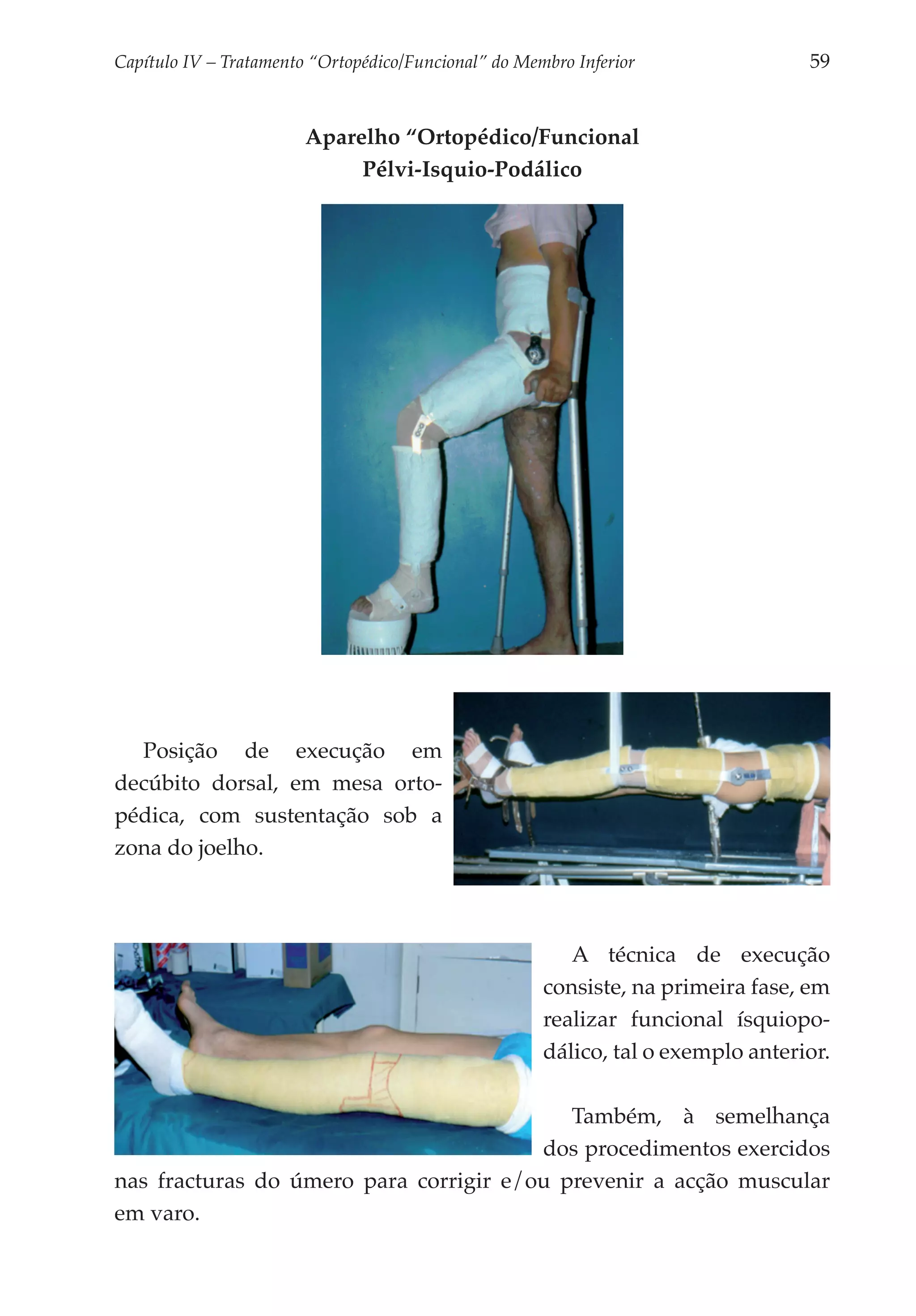 Capítulo IV – Tratamento “Ortopédico/Funcional” do Membro Inferior 	               59


                        Aparelho “Ortopédico/Funcional
                             Pélvi-Isquio-Podálico




  Posição de execução em
decúbito dorsal, em mesa orto­
pédica, com sustentação sob a
zona do joelho.



                                                          A técnica de execução
                                                       consiste, na pri­ eira fase, em
                                                                        m
                                                       realizar funcional ísquio­ o­
                                                                                   p
                                                       dálico, tal o exemplo anterior.

                                            Também, à semelhança
                                         dos procedi­ entos exercidos
                                                    m
nas fracturas do úme­ o para corrigir e/ou prevenir a acção muscular
                    r
em varo.
 