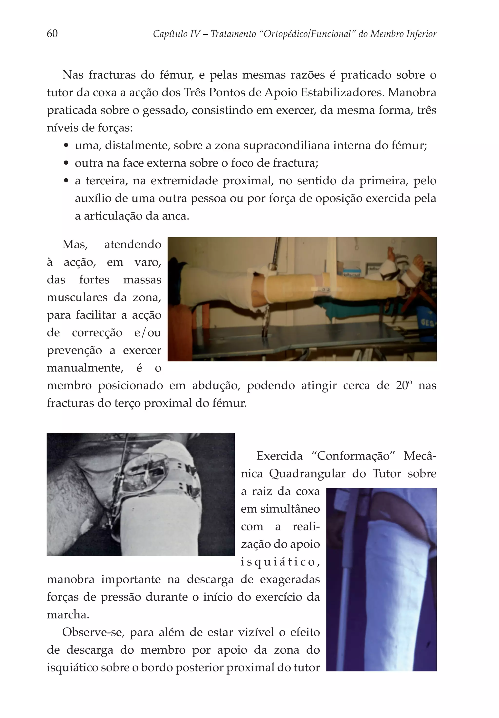 60	                Capítulo IV – Tratamento “Ortopédico/Funcional” do Membro Inferior



   Nas fracturas do fémur, e pelas mesmas razões é praticado sobre o
tutor da coxa a acção dos Três Pontos de Apoio Estabilizadores. Manobra
praticada sobre o gessado, consistindo em exercer, da mesma forma, três
níveis de forças:
   •	 uma, distalmente, sobre a zona supracondiliana interna do fémur;
   •	 outra na face externa sobre o foco de fractura;
   •	 a terceira, na extremidade proximal, no sentido da primeira, pelo
      auxílio de uma outra pessoa ou por força de oposição exercida pela
      a articulação da anca.

   Mas, atendendo
à acção, em varo,
das fortes massas
musculares da zona,
para facilitar a acção
de correcção e/ou
prevenção a exercer
manualmente, é o
membro posicionado em abdução, podendo atingir cerca de 20º nas
fracturas do terço proximal do fémur.



                                        Exercida “Conformação” Mecâ­
                                     nica Qua­ rangular do Tutor sobre
                                                d
                                     a raiz da coxa
                                     em simultâneo
                                     com a reali­
                                     zação do apoio
                                     isquiá­ ico,
                                              t
manobra importante na descarga de exageradas
forças de pressão durante o início do exercício da
marcha.
   Observe-se, para além de estar vizível o efeito
de descarga do membro por apoio da zona do
isquiático sobre o bordo posterior proximal do tutor
 