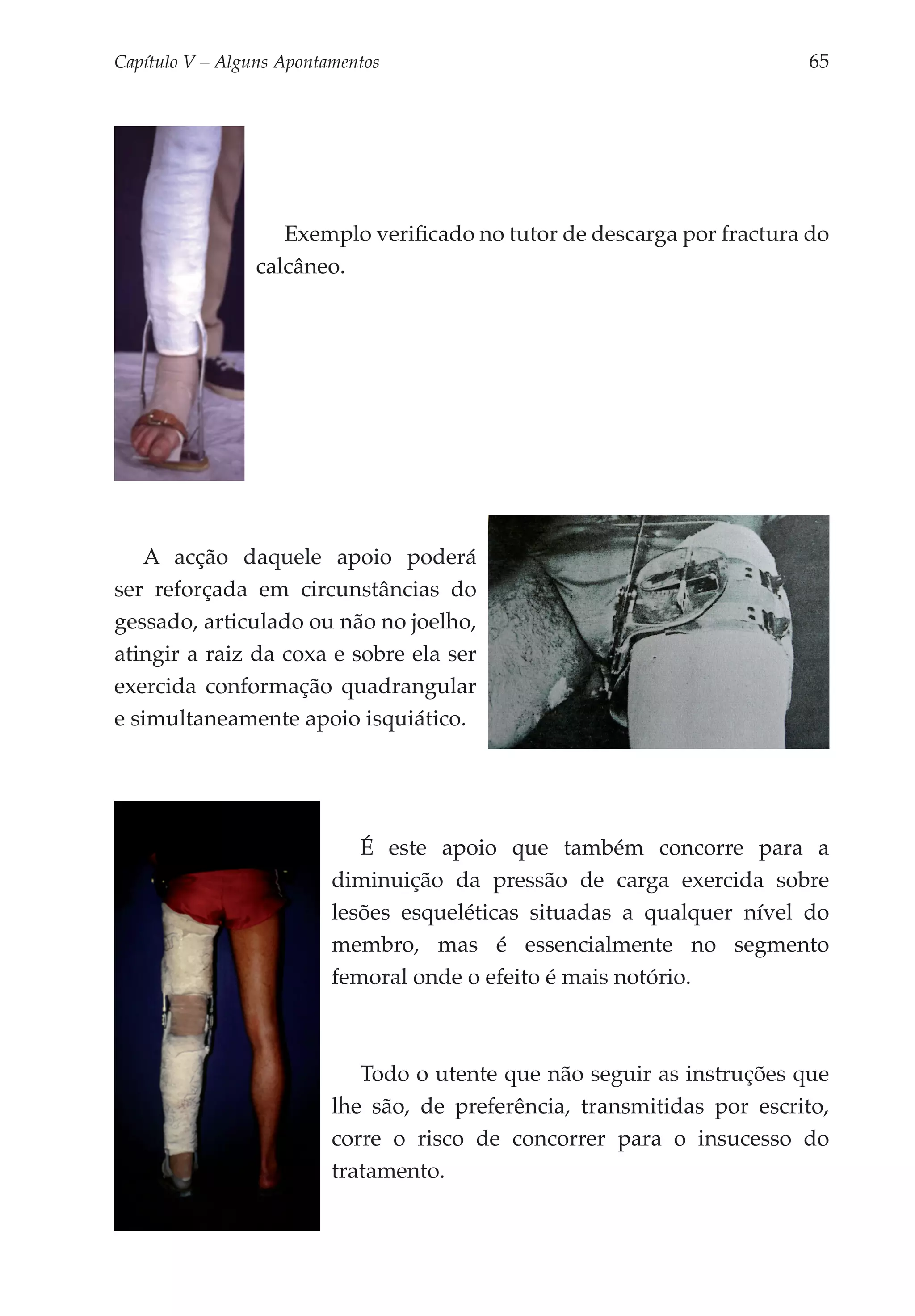Capítulo V – Alguns Apontamentos 	                                       65




                    Exemplo verificado no tutor de descarga por fractura do
                 calcâneo.




   A acção daquele apoio poderá
ser reforçada em circunstâncias do
gessado, articulado ou não no joelho,
atingir a raiz da coxa e sobre ela ser
exercida conformação quadrangular
e simultaneamente apoio isquiático.




                             É este apoio que também concorre para a
                          diminuição da pressão de carga exercida sobre
                          lesões esqueléticas situadas a qualquer nível do
                          membro, mas é essencialmente no segmento
                          femoral onde o efeito é mais notório.



                             Todo o utente que não seguir as instruções que
                          lhe são, de preferência, transmitidas por escrito,
                          corre o risco de concorrer para o insucesso do
                          tratamento.
 
