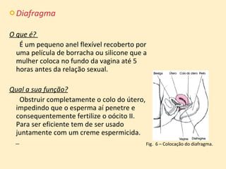 Diafragma O que é?    É um pequeno anel flexível recoberto por uma película de borracha ou silicone que a mulher coloca no fundo da vagina até 5  horas antes da relação sexual.  Qual a sua função?   Obstruir completamente o colo do útero, impedindo que o esperma aí penetre e consequentemente fertilize o oócito II. Para ser eficiente tem de ser usado juntamente com um creme espermicida.    Fig.  6 – Colocação do diafragma. 