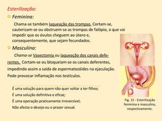 Esterilização: Feminina:   Chama-se também  laqueação das trompas.  Cortam-se, cauterizam-se ou obstruem-se as trompas de falópio, o que vai impedir que os óvulos cheguem ao útero e, consequentemente, que sejam fecundados. Masculina:   Chama-se  Vasectomia  ou  laqueação dos canais defe- rentes.  Cortam-se ou bloqueiam-se os canais deferentes, impedindo assim a saída de espermatozóides na ejaculação. Pode provocar inflamação nos testículos.   É uma solução para quem não quer voltar a ter filhos; É uma solução definitiva e eficaz; É uma operação praticamente irreversível; Não afecta o desejo ou o prazer sexual. Fig. 15 - Esterilização feminina e masculina, respectivamente. 