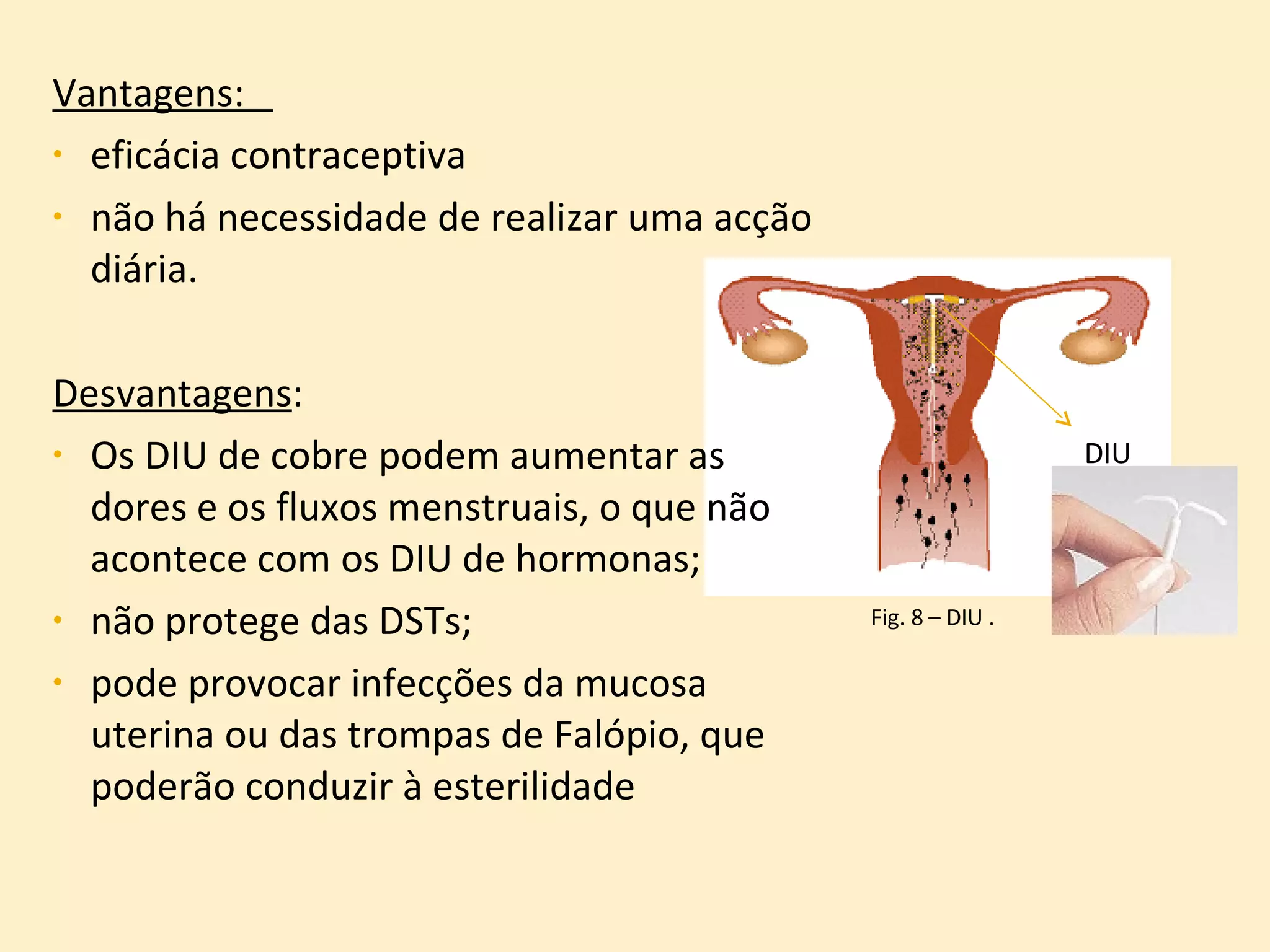 Vantagens:  eficácia contraceptiva  não há necessidade de realizar uma acção diária.  Desvantagens :  Os DIU de cobre podem aumentar as dores e os fluxos menstruais, o que não acontece com os DIU de hormonas; não protege das DSTs; pode provocar infecções da mucosa uterina ou das trompas de Falópio, que poderão conduzir à esterilidade Fig. 8 – DIU . DIU 