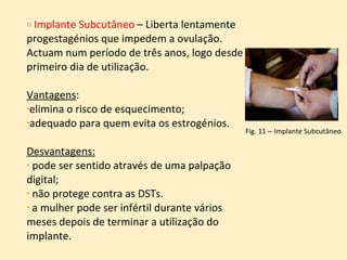 Implante Subcutâneo  – Liberta lentamente progestagénios que impedem a ovulação. Actuam num período de três anos, logo desde o primeiro dia de utilização.  Vantagens :  elimina o risco de esquecimento;  adequado para quem evita os estrogénios. Desvantagens:   pode ser sentido através de uma palpação digital;  não protege contra as DSTs. a mulher pode ser infértil durante vários meses depois de terminar a utilização do implante. Fig. 11  –  Implante Subcutâneo . 