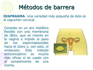 Métodos de barrera DIAFRAGMA . Una variedad más pequeña de éste es el capuchón cervical . Consiste en un aro metálico flexible con una membrana de látex, que se inserta en la vagina e impide el paso de los espermatozoides hacia el útero y, con esto, el embarazo. Este método anticonceptivo es mucho más eficaz si es usado con el complemento de una crema.  
