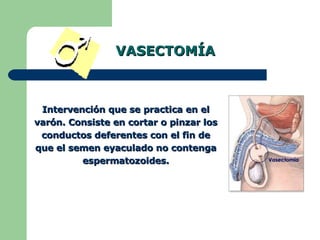 VASECTOMÍA Intervención que se practica en el varón. Consiste en cortar o pinzar los conductos deferentes con el fin de que el semen eyaculado no contenga espermatozoides. 