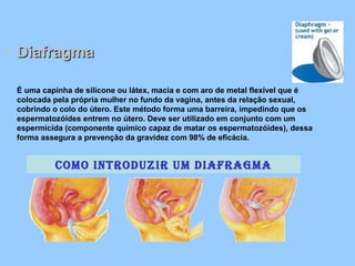 • DiafragmaDiafragma
É uma capinha de silicone ou látex, macia e com aro de metal flexível que é
colocada pela própria mulher no fundo da vagina, antes da relação sexual,
cobrindo o colo do útero. Este método forma uma barreira, impedindo que os
espermatozóides entrem no útero. Deve ser utilizado em conjunto com um
espermicida (componente químico capaz de matar os espermatozóides), dessa
forma assegura a prevenção da gravidez com 98% de eficácia.
Como introduzir um diafragma
 