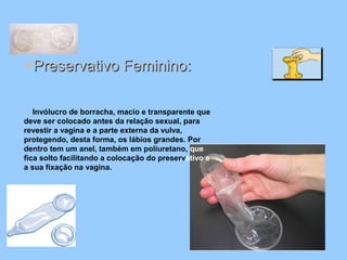 ●Preservativo Feminino:Preservativo Feminino:
Invólucro de borracha, macio e transparente que
deve ser colocado antes da relação sexual, para
revestir a vagina e a parte externa da vulva,
protegendo, desta forma, os lábios grandes. Por
dentro tem um anel, também em poliuretano, que
fica solto facilitando a colocação do preservativo e
a sua fixação na vagina.
 