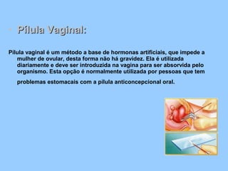 • Pílula Vaginal:Pílula Vaginal:
Pílula vaginal é um método a base de hormonas artificiais, que impede a
mulher de ovular, desta forma não há gravidez. Ela é utilizada
diariamente e deve ser introduzida na vagina para ser absorvida pelo
organismo. Esta opção é normalmente utilizada por pessoas que tem
problemas estomacais com a pílula anticoncepcional oral.
 
 