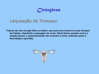 Cirúrgicos
• Laqueação de Trompas:Laqueação de Trompas:
Trata-se de uma cirurgia feita na mulher, que corta e/ou amarra as suas trompas
de Falópio, impedindo a passagem do óvulo. Desta forma, quando ocorre a
relação sexual, o espermatozóide não encontra o óvulo, evitando assim a
fecundação e gravidez.
 