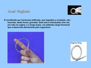 Anel Vaginal: É constituído por hormonas artificiais, que impedem a ovulação, não havendo, desta forma, gravidez. Este anel é introduzido uma vez por mês na vagina, e a longo prazo, vai soltando carga hormonal que é absorvida diariamente pelo organismo.    