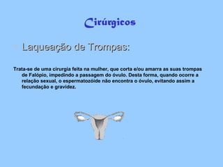 Cirúrgicos  Laqueação de Trompas: Trata-se de uma cirurgia feita na mulher, que corta e/ou amarra as suas trompas de Falópio, impedindo a passagem do óvulo. Desta forma, quando ocorre a relação sexual, o espermatozóide não encontra o óvulo, evitando assim a fecundação e gravidez.  