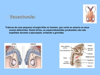 Vasectomia: Trata-se de uma pequena cirurgia feita no homem, que corta ou amarra os seus canais deferentes. Desta forma, os espermatozóides produzidos não são expelidos durante a ejaculação, evitando a gravidez.  