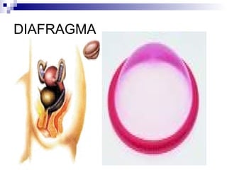 DIAFRAGMA 