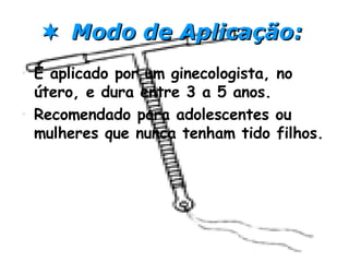    Modo de Aplicação:   É aplicado por um ginecologista, no útero, e dura entre 3 a 5 anos. Recomendado para adolescentes ou mulheres que nunca tenham tido filhos. 