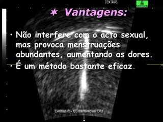    Vantagens: Não interfere com o acto sexual, mas provoca menstruações abundantes, aumentando as dores. É um método bastante eficaz . 