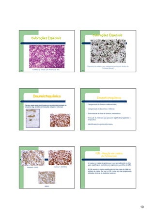 10
Candida sp. corada pela técnica do PASCandida sp. corada pela técnica do PASFNFN
Colorações EspeciaisColorações Especiais
Pigmento de melanina em melanoma corado pela técnica de
Fontana-Masson
Pigmento de melanina em melanoma corado pela técnica de
Fontana-Masson
FNFN
Colorações EspeciaisColorações Especiais
ImunoistoquímicaImunoistoquImunoistoquíímicamica
TTéécnica usada para identificacnica usada para identificaçção de constituintes teciduais ouão de constituintes teciduais ou
celulares (celulares (AgAg), atrav), atravéés de interas de interaçções Antões Antíígenogeno-- AnticorpoAnticorpo
Imunohistoquímica
l Categorização de tumores indiferenciados;
l Categorização de leucemias e linfomas;
l Determinação do local de tumores metastáticos;
l Detecção de moléculas que possuem significado prognóstico e
terapêutico;
l Identificação de agentes infecciosos.
Linfoma B (CD20) Linfoma T (CD45RO)
HMB45
PCR – Reação em cadeia
da Polimerase
ll A reaA reaçção em cadeia da polimeraseão em cadeia da polimerase éé um procedimentoum procedimento inin vitrovitro,,
para amplificapara amplificaçção enzimão enzimáática de seqtica de seqüüências especências especííficas de DNA.ficas de DNA.
ll A PCR permite a rA PCR permite a ráápida amplificapida amplificaçção de uma cão de uma cóópia de DNA empia de DNA em
milhões de cmilhões de cóópias. Por isso, a PCRpias. Por isso, a PCR éé uma das mais amplamenteuma das mais amplamente
utilizadas tutilizadas téécnicas da medicina moderna.cnicas da medicina moderna.
 