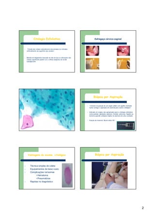 2
l “Estudo das células naturalmente descamadas ou retiradas
artificialmente da superfície dos tecidos”.
l Método de diagnóstico baseado no fato de que as alterações das
células superficiais podem ser o reflexo daquelas do tecido
subadjacente
Citologia Esfoliativa Esfregaço cérvico-vaginal
l “Consiste na punção de um órgão sólido com agulha montada
numa seringa e aspiração do material para exame citológico”.
l Indicado em órgãos não apropriados para a citologia esfoliativa
como pulmão, glandulas salivares, tireoide, pâncreas, fígados ou
tumores quando a biópsia implica na abertura de uma cavidade.
l Fixação do material: Álcool etílico 95º
Biópsia por Aspiração
Vantagens do exame citológico
l Técnica simples de coleta
l Equipamentos de baixo custo
l Complicações raríssimas
•Hematoma
•Pneumotórax
l Rapidez no diagnóstico
Biópsia por Aspiração
 