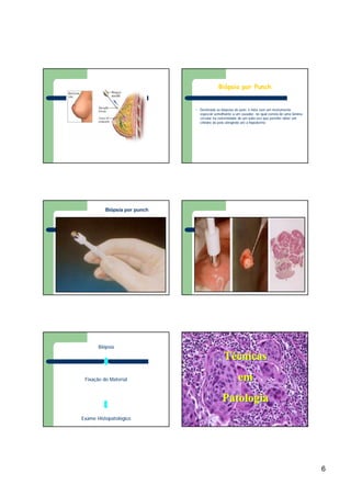 6
l Destinada as biópsias de pele, é feita com um instrumento
especial semelhante a um vazador, no qual consta de uma lâmina
circular na extremidade de um tubo oco que permite obter um
cilíndro de pele atingindo até a hipoderme.
Biópsia por Punch
Biópsia por punch
Biópsia
Fixação do Material
Exame Histopatológico
Técnicas
em
Patologia
TTéécnicascnicas
emem
PatologiaPatologia
FNFN
 