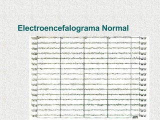 Electroencefalograma Normal 
