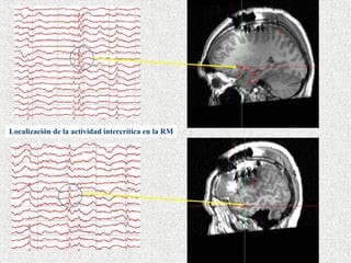 Localización de la actividad intercrítica en la RM 