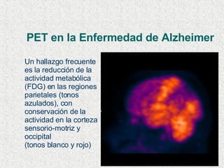 PET en la Enfermedad de Alzheimer Un hallazgo frecuente es la reducción de la actividad metabólica (FDG) en las regiones parietales (tonos azulados), con conservación de la actividad en la corteza sensorio-motriz y occipital (tonos blanco y rojo) 