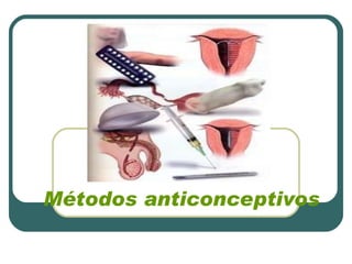 Métodos anticonceptivos 
