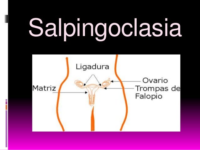 Resultado de imagen para cual es el método salpingoclasia