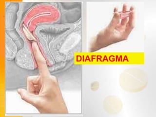 DIAFRAGMA
 