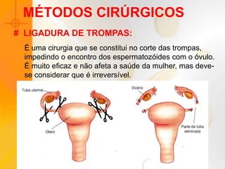 MÉTODOS CIRÚRGICOS
É uma cirurgia que se constitui no corte das trompas,
impedindo o encontro dos espermatozóides com o óvulo.
É muito eficaz e não afeta a saúde da mulher, mas deve-
se considerar que é irreversível.
# LIGADURA DE TROMPAS:
 