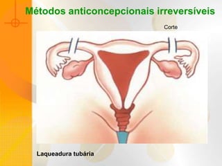 Corte
Métodos anticoncepcionais irreversíveis
Laqueadura tubária
 