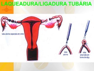 LAQUEADURA/LIGADURA TUBÁRIA
 