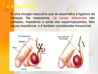 É uma cirurgia masculina que se assemelha à ligadura de
trompas. Na vasectomia, os canais deferentes são
cortados, impedindo a saída dos espermatozóides. Não
causa impotência, e é também considerada irreversível.
# VASECTOMIA:
 