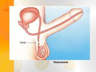 Vasectomia
Corte
 