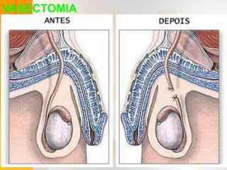 VASECTOMIA
 