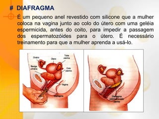 É um pequeno anel revestido com silicone que a mulher
coloca na vagina junto ao colo do útero com uma geléia
espermicida, antes do coito, para impedir a passagem
dos espermatozóides para o útero. É necessário
treinamento para que a mulher aprenda a usá-lo.
# DIAFRAGMA
 