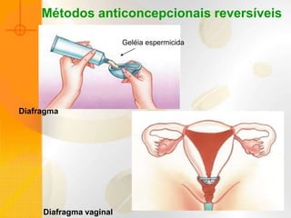 Diafragma vaginal
Diafragma
Métodos anticoncepcionais reversíveis
Geléia espermicida
 