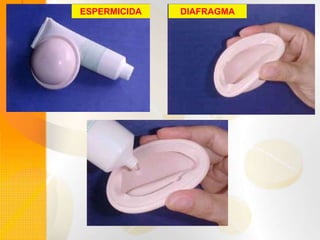 ESPERMICIDA DIAFRAGMA
 