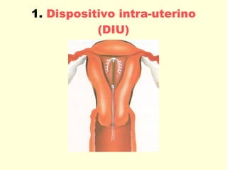 1.  Dispositivo intra-uterino (DIU) 