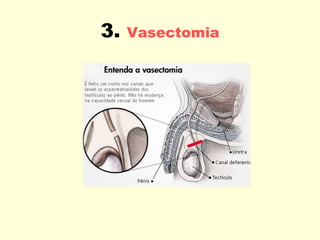 3.   Vasectomia 
