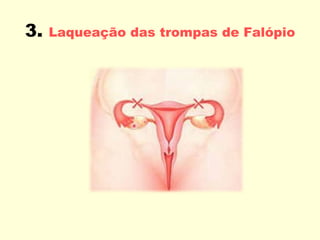 3.   Laqueação das trompas de Falópio 