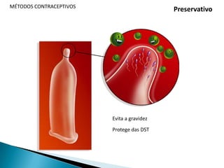 MÉTODOS CONTRACEPTIVOSPílula combinadaAdministração- Pílula combinada 1º dia da menstruação