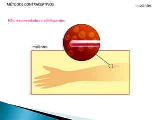  Hemorragia de privação na pausa