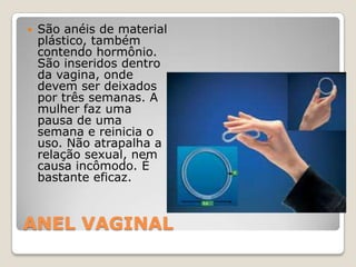 ANEL VAGINALSão anéis de material plástico, também contendo hormônio. São inseridos dentro da vagina, onde devem ser deixados por três semanas. A mulher faz uma pausa de uma semana e reinicia o uso. Não atrapalha a relação sexual, nem causa incômodo. É bastante eficaz.
