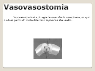 Vasovasostomia é a cirurgia de reversão da vasectomia, na qual
as duas partes do ducto deferente separadas são unidas.
 