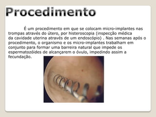 É um procedimento em que se colocam micro-implantes nas
trompas através do útero, por histeroscopia (inspecção médica
da cavidade uterina através de um endoscópio) . Nas semanas após o
procedimento, o organismo e os micro-implantes trabalham em
conjunto para formar uma barreira natural que impede os
espermatozóides de alcançarem o óvulo, impedindo assim a
fecundação.
 