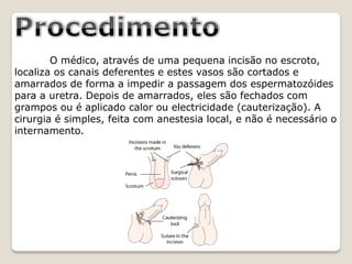 O médico, através de uma pequena incisão no escroto,
localiza os canais deferentes e estes vasos são cortados e
amarrados de forma a impedir a passagem dos espermatozóides
para a uretra. Depois de amarrados, eles são fechados com
grampos ou é aplicado calor ou electricidade (cauterização). A
cirurgia é simples, feita com anestesia local, e não é necessário o
internamento.
 