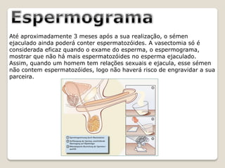 Até aproximadamente 3 meses após a sua realização, o sémen
ejaculado ainda poderá conter espermatozóides. A vasectomia só é
considerada eficaz quando o exame do esperma, o espermograma,
mostrar que não há mais espermatozóides no esperma ejaculado.
Assim, quando um homem tem relações sexuais e ejacula, esse sémen
não contem espermatozóides, logo não haverá risco de engravidar a sua
parceira.
 