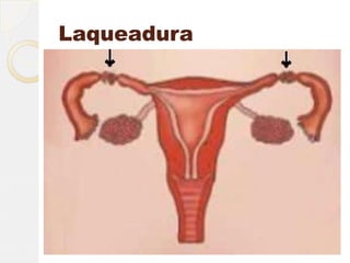 Laqueadura
   A laqueadura, também conhecida por
    ligadura de trompas, é um processo
    cirúrgico feito com objetivo contraceptivo,
    ou seja, que impede que a mulher
    engravide novamente.
   Nesse procedimento, as tubas uterinas
    são obstruídas, cortadas e/ou amarradas,
    impedindo a descida do óvulo e subida do
    espermatozóide, tendo como resultado
    um índice de concepção menor que 1%.
 