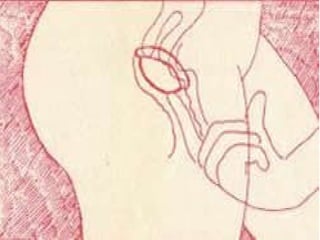 Dobre-o ao meio,
  formando um oito, e
introduza-o na vagina,
   cobrindo o colo do
         útero.
 